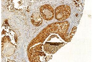 ABIN6264959 and ABIN6272887 at 1/100 staining Human breast cancer by IHC-P.