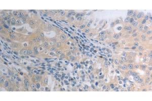 Immunohistochemistry of paraffin-embedded Human ovarian cancer tissue using SHH Polyclonal Antibody at dilution 1:40 (Sonic Hedgehog 抗体)