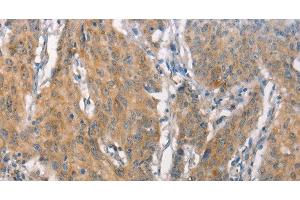 Immunohistochemistry of paraffin-embedded Human gastric cancer tissue using CEACAM6 Polyclonal Antibody at dilution 1:50 (CEACAM6 抗体)