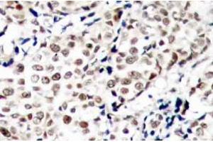 Immunohistochemistry (IHC) analysis of p-Chk1 (pSer345) pAb in paraffin-embedded human breast carcinoma tissue (CHEK1 抗体  (pSer345))