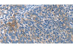 Immunohistochemistry of paraffin-embedded Human cervical cancer tissue using AHR Polyclonal Antibody at dilution 1:50 (Aryl Hydrocarbon Receptor 抗体)