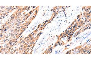 Immunohistochemistry of paraffin-embedded Human esophagus cancer using GNRHR Polyclonal Antibody at dilution of 1:117 (GNRHR 抗体)