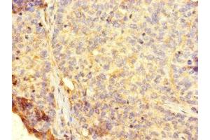 Immunohistochemistry of paraffin-embedded human ovarian cancer using ABIN7154641 at dilution of 1:100 (RHEBL1 抗体  (AA 1-180))