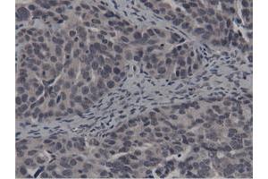 Immunohistochemical staining of paraffin-embedded Carcinoma of Human kidney tissue using anti-BTN1A1 mouse monoclonal antibody. (BTN1A1 抗体)