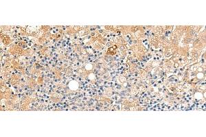 Immunohistochemistry of paraffin-embedded Human liver cancer tissue using MEST Polyclonal Antibody at dilution of 1:50(x200) (MEST 抗体)