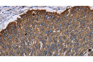 Immunohistochemistry of paraffin-embedded Human lung cancer using KRT31 Polyclonal Antibody at dilution of 1:30 (Keratin 31 抗体)