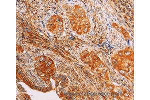 Immunohistochemistry of Human cervical cancer using SLC25A4 Polyclonal Antibody at dilution of 1:40 (SLC25A4 抗体)