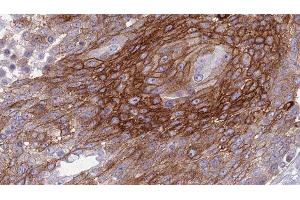 ABIN6277297 at 1/100 staining Human urothelial cancer tissue by IHC-P. (Betacellulin 抗体  (N-Term))