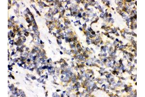 Anti- Ataxin 3 Picoband antibody, IHC(P) IHC(P): Human Lung Cancer Tissue (Ataxin 3 抗体  (C-Term))
