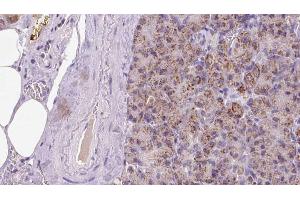 ABIN6273287 at 1/100 staining Human pancreas cancer tissue by IHC-P. (Parvin, beta 抗体  (C-Term))