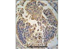 Formalin-fixed and paraffin-embedded human lung carcinoma tissue reacted with RIP3 (RIPK3) antibody (C-term) (ABIN392275 and ABIN2841945) , which was peroxidase-conjugated to the secondary antibody, followed by DAB staining. (RIPK3 抗体  (C-Term))