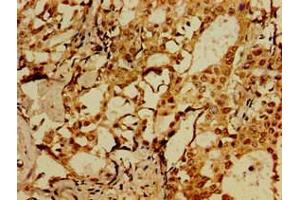 Immunohistochemistry of paraffin-embedded human breast cancer using ABIN7175658 at dilution of 1:100 (SORCS1 抗体  (AA 34-175))