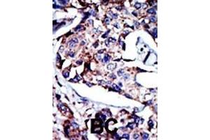 Formalin-fixed and paraffin-embedded human cancer tissue reacted with the primary antibody, which was peroxidase-conjugated to the secondary antibody, followed by DAB staining. (DGKD 抗体  (C-Term))