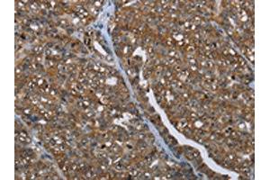 The image on the left is immunohistochemistry of paraffin-embedded Human ovarian cancer tissue using ABIN7191991(PRDM2 Antibody) at dilution 1/25, on the right is treated with synthetic peptide. (PRDM2 抗体)