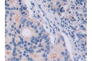 DAB staining on IHC-P; Samples: Human Prostate cancer Tissue (IL18R1 抗体  (AA 147-255))