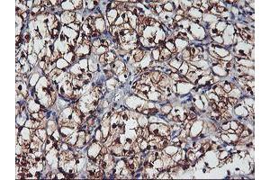 Immunohistochemical staining of paraffin-embedded Carcinoma of Human kidney tissue using anti-NNMT mouse monoclonal antibody. (NNMT 抗体)