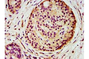 IHC image of ABIN7143720 diluted at 1:500 and staining in paraffin-embedded human pancreatic cancer performed on a Leica BondTM system. (AGPS 抗体  (AA 279-400))