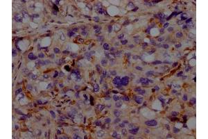 IHC image of ABIN7127322 diluted at 1:100 and staining in paraffin-embedded human liver cancer performed on a Leica BondTM system. (Recombinant ACVRL1 抗体)