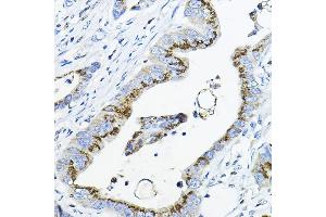 Immunohistochemistry of paraffin-embedded human colon carcinoma using G Rabbit pAb (ABIN6131444, ABIN6140942, ABIN6140944 and ABIN6218180) at dilution of 1:100 (40x lens). (GALNT3 抗体  (AA 1-140))