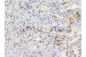 ABIN6255569 and ABIN6267648 at 1/100 staining human lung squamous cell carcinoma by IHC-P.