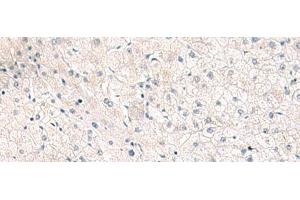 Immunohistochemistry of paraffin-embedded Human liver cancer tissue using FGFR4 Polyclonal Antibody at dilution of 1:25(x200) (FGFR4 抗体)