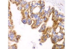 Immunohistochemistry of paraffin-embedded Human liver cancer using GLUD2 Polyclonal Antibody at dilution of 1:100 (40x lens). (GLUD2 抗体)