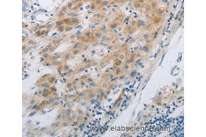 Immunohistochemistry of Human liver cancer using GJB6 Polyclonal Antibody at dilution of 1:30 (GJB6 抗体)