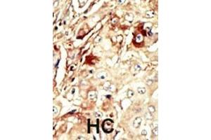 Formalin-fixed and paraffin-embedded human cancer tissue reacted with the primary antibody, which was peroxidase-conjugated to the secondary antibody, followed by AEC staining. (WEE1 抗体  (AA 144-173))