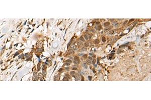 Immunohistochemistry of paraffin-embedded Human thyroid cancer tissue using HEATR9 Polyclonal Antibody at dilution of 1:110(x200) (C17orf66 抗体)