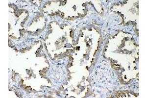 IHC testing of FFPE human lung cancer tissue with DYNLT1 antibody at 1ug/ml. (DYNLT1 抗体)