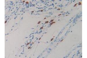IHC-P analysis of Human Rectum Cancer Tissue, with DAB staining. (Resistin 抗体  (AA 17-108))