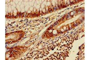 Immunohistochemistry of paraffin-embedded human colon cancer using ABIN7153453 at dilution of 1:100 (Galectin 3 抗体  (AA 2-250))