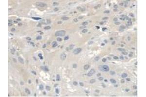 IHC-P analysis of Human Esophagus Cancer Tissue, with DAB staining. (ANTXR2 抗体  (AA 34-318))