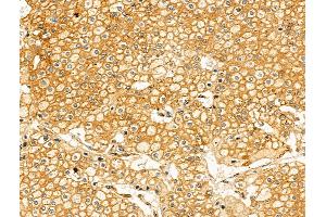 Phospho-PKA R2 (Ser99) Antibody at 1/100 staining Human kidney cancer by IHC-P.