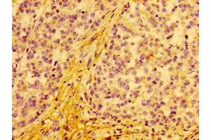 IHC image of ABIN7149142 diluted at 1:100 and staining in paraffin-embedded human colon cancer performed on a Leica BondTM system. (COX15 抗体  (AA 1-67))