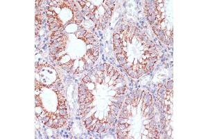 Immunohistochemistry of paraffin-embedded human colon carcinoma using HIGD1A antibody (ABIN7267642) at dilution of 1:100 (40x lens). (HIGD1A 抗体  (AA 1-93))