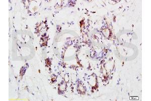 Formalin-fixed and paraffin embedded human breast carcinoma labeled with Anti-CCR3 Polyclonal Antibody, Unconjugated (ABIN738651) at 1:200 followed by conjugation to the secondary antibody and DAB staining. (CCR3 抗体  (AA 251-355))