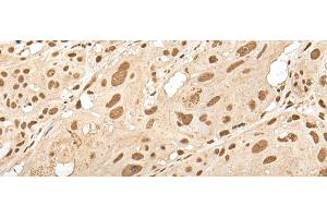 Immunohistochemistry of paraffin-embedded Human esophagus cancer tissue using ZNF274 Polyclonal Antibody at dilution of 1:35(x200) (ZNF274 抗体)