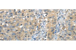Immunohistochemistry of paraffin-embedded Human breast cancer using ISM2 Polyclonal Antibody at dilution of 1/45 (Isthmin 2 抗体)
