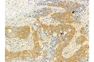 HDLBP Mouse Monoclonal Antibody at 1/100 staining human lung cancer and adjacent non-tumor tissue by IHC-P. (HDLBP 抗体  (N-Term))