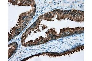 Immunohistochemical staining of paraffin-embedded Carcinoma of liver tissue using anti-RDH11 mouse monoclonal antibody. (RDH11 抗体)