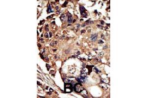 Formalin-fixed and paraffin-embedded human cancer tissue reacted with PACSIN1 polyclonal antibody  , which was peroxidase-conjugated to the secondary antibody, followed by DAB staining.
