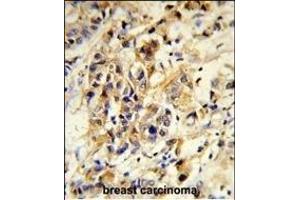 Formalin-fixed and paraffin-embedded human breast carcinoma reacted with RPGRIP1 Antibody (Center), which was peroxidase-conjugated to the secondary antibody, followed by DAB staining. (RPGRIP1 抗体  (AA 530-557))