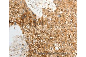 Immunohistochemistry of Human ovarian cancer using TENM3 Polyclonal Antibody at dilution of 1:50 (TENM3 抗体)