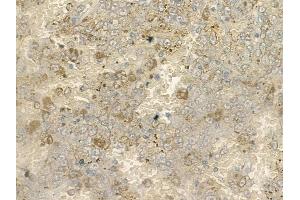 ABIN6260902 and ABIN6273102 at 1/100 staining human melanoma by IHC-P.