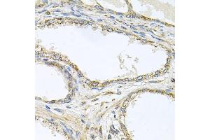 Immunohistochemistry of paraffin-embedded human prostate using TNFRSF10A antibody (ABIN5973697) at dilution of 1/100 (40x lens). (TNFRSF10A 抗体)