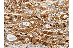 The image on the left is immunohistochemistry of paraffin-embedded Human gastic cancer tissue using ABIN7130484(OASL Antibody) at dilution 1/20, on the right is treated with fusion protein. (OASL 抗体)