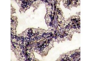 IHC analysis of FFPE prostate carcinoma tissue stained with Lactoferrin antibody. (Lactoferrin 抗体  (AA 219-248))