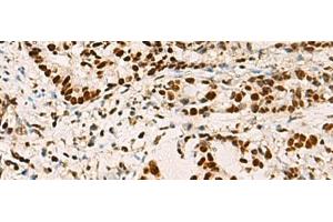 Immunohistochemistry of paraffin-embedded Human cervical cancer tissue using ELF5 Polyclonal Antibody at dilution of 1:70(x200) (ELF5 抗体)