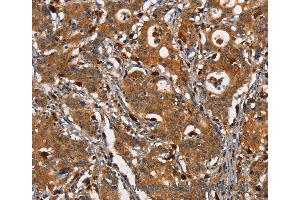 Immunohistochemistry of Human thyroid cancer using CEACAM3 Polyclonal Antibody at dilution of 1:30 (CEACAM3 抗体)